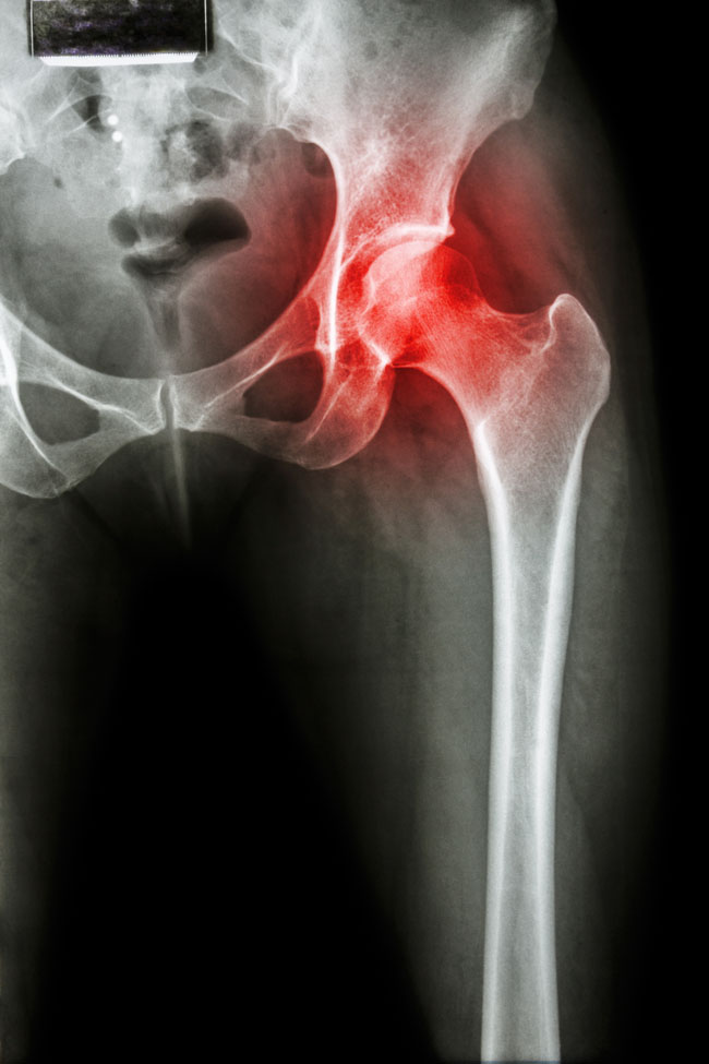 röntgen a csípőízület fájdalmáért