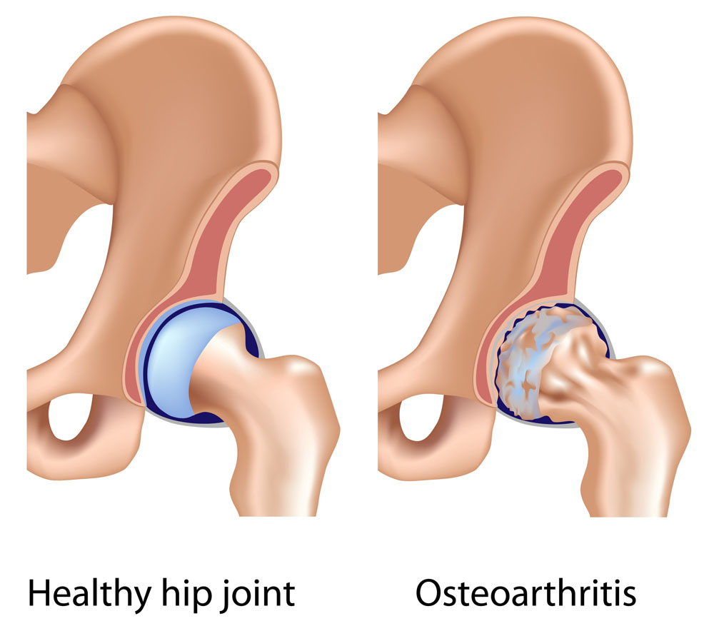 csípő osteoarthritis kezelés