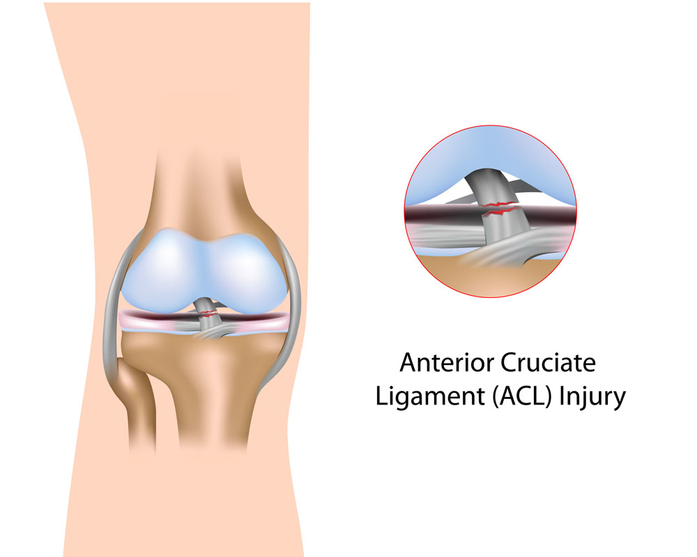 térd ligamentum-törés kezelésére duzzadt ízület a lábon nincs fájdalom