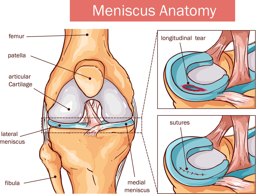 Porcleválás, meniscus szakadás