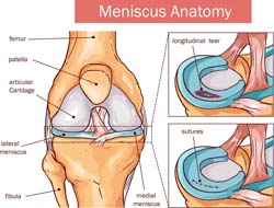 Holdasporc (meniscus) sérülés