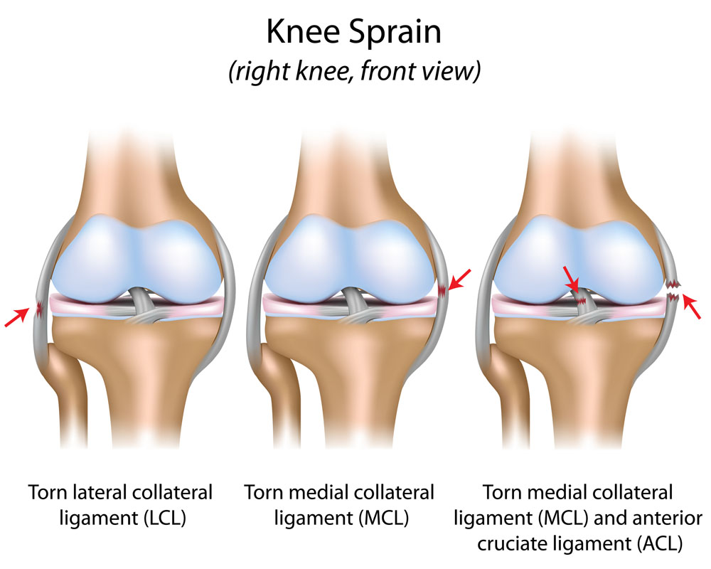 A térdízület külső oldalsó ligamentuma fáj