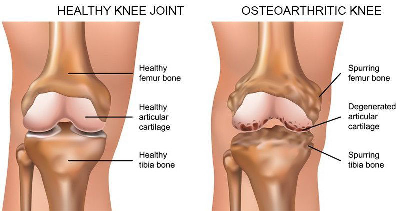 térdbetegség osteoarthrosis)